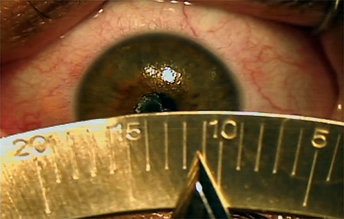 Figure 3 Calipers setting during precision white-to-white measurement. Courtesy of Vance Thompson.