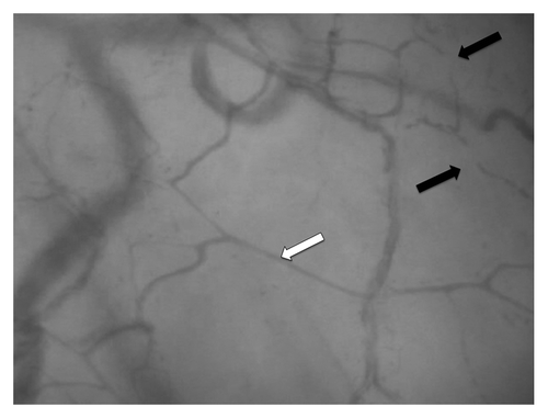 Figure 1. Sublingual microcirculation in sepsis. Photograph of the sublingual microcirculation in a patient with septic shock using a sidestream dark field (SDF) imaging device. The white arrow shows a perfused capillary, the black arrows identify a stopped flow capillary.