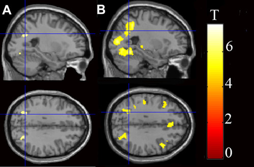 Figure 1 Task fMRI results for the comparison “PD vs HC”. (A) During the heartbeat vs resting-state condition, PD patients showed increased activity in the bilateral superior parietal lobule [SPL; p < 0.05, family wise error (FWE) corrected]. (B) During the “pure tones vs resting-state” condition, PD patients showed increased activity in the bilateral SPL (p < 0.05, FWE corrected).