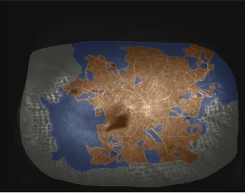 Figure 2 Widefield FA after initial targeted retinal photocoagulation.