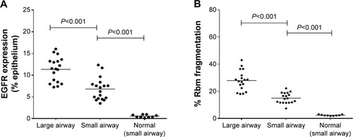 Figure 2 (A) Percentage of large-airway epithelium in CAL patients stained for EGFR compared with CAL small airway and normal control small airway. (B) Percentage of Rbm fragmentation (total length of clefts as percentage of the total length of Rbm) in large airway in CAL patients versus CAL small airway and in normal control small airway.Abbreviations: CAL, chronic airflow limitation; EGFR, epidermal growth factor receptor; Rbm, reticular basement membrane.