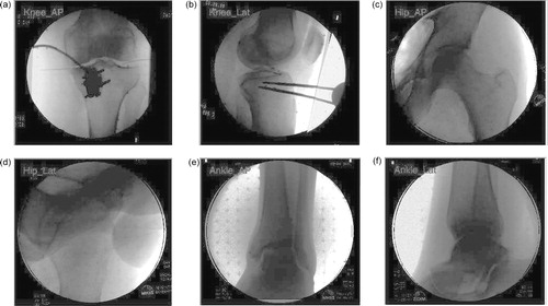 Figure 2. Fluoroscopic images used for landmark registration include (a) knee AP, (b) knee lateral, and optionally (c) hip AP, (d) hip lateral, (e) ankle AP, and (f) ankle lateral images.