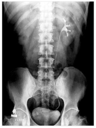 Figure 4 (B) Subsequent IVU of same patient shows complete obstruction on right side due to a distal ureteral calculus.