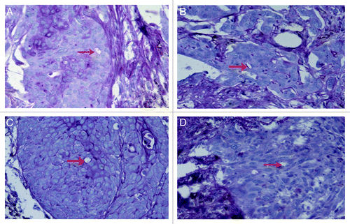 Figure 2. CD31-PAS dual staining to visualize different morphologies of the basement membrane-like structure formed by PAS-positive (rose red) substance in vascular mimicry in prostate cancer tissues. (A) Complete loop; (B) arc; (C) line; (D) absent, without PAS-positive substance. Original magnification: × 200.