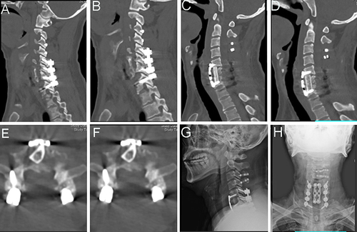 Figure 9 Postoperative examination images after the second surgery. (A and B) Sagittal CT image (posterior); (C and D) sagittal CT image C5-7 instrumentation (Anterior); (E) C5 lower edge of vertebral body axial CT image; (F) Upper edge of C7 vertebral body axial CT image. Lateral (G) and anteroposterior (H) X-ray.