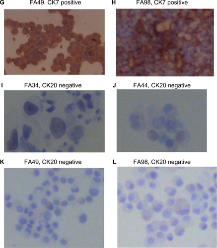 Figure 2 Immunohistochemical staining with TTF1, CK7, and CK20 on paraffin cell blocks for all four lung adenocarcinoma cell lines.