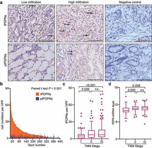 Figure 1. Accumulated tPDPNs in gastric cancer are correlated with tumor progression. (a) Representative immunohistochemistry (IHC) images of tumor-infiltrating PDPN+ cells (tPDPNs) and peritumor-infiltrating PDPN+ cells (ptPDPNs) in gastric tissues. Arrow heads show tPDPNs and ptPDPNs. Scale bars, 100 μm. (b) IHC evaluation of tPDPNs versus ptPDPNs. Paired t test. (c) Distribution of tPDPNs across tumor-node-metastasis (TNM) stage. One-way ANOVA followed by Tukey’s multiple comparisons. (d) Distribution of PDPN mRNA level across TNM stage. One-way ANOVA followed by Tukey’s multiple comparisons. ns refers to not significant