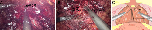 Figure 1 The first layer of the reconstruction of the posterior wall of total urethral reconstruction of “Sandwich”. (A) The structural location of the medial dorsal raphe (MDR) during the operation. (B) The structural location of the severed end of Denonvillier’s fascia. (C) The severed Denonvillier’s fascia was sutured with MDR.