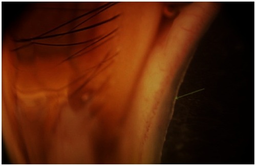 Figure 2 Anterior segment photograph showing posterior embryotoxon, an anteriorly displaced Schwalbe’s line.