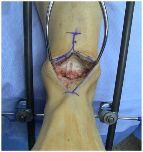 Figure 3 Anterior approach to ankle for hemitalus osteochondral allograft.