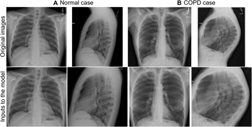 Figure 2 Top row. Example of frontal and lateral chest radiograph images (2048 × 2048 pixels, 12 bits per pixel) for (a) normal case: 36-year-old male, never smoker, pulmonary function test FEV1/FVC = 0.91, FEV1 = 0.89 and (b) COPD case: 62-year-old female, 75 pack-year smoking history, pulmonary function test FEV1/FVC = 0.51, FEV1 = 0.27. The FEV1/FVC ratio is the percentage of the total amount of air that can be exhaled from the lungs during the first second of forced exhalation. In COPD (FEV1/FVC <0.7), air is trapped in the lungs resulting in high lung volumes, flattened hemidiaphragms, increased retrosternal clear space, vascular pruning and lucent lungs as demonstrated in (b) images. Bottom row. Associated pre-processed images used as inputs to the deep learning image model (224 × 224 pixels, 8 bits per pixel) for the example (a) normal case and (b) COPD case. ImageNet normalization is not included for visualization purposes.