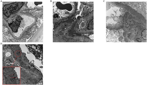 Figure 2. Representative examples according to the tertiles of GBM thickness in PMN patients. A. Electron microscopy of a patient in Group 1 (GBM thickness ≤ 1100 nm). B. Electron microscopy of a patient in Group 2 (GBM thickness 1100–1300 nm). C. Electron microscopy of a patient in Group 3 (GBM thickness > 1300 nm) (original print magnifications ×8000. Scale bar = 1.0 μm). D. Representative image of measuring the GBM thickness (Scale bar = 1.0 μm).