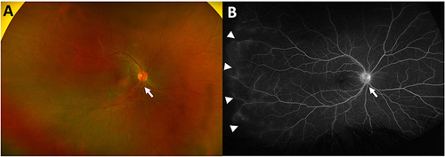 Figure 1 Fundus photo (A) and late phase fluorescein angiography (B) of a representative case of HLA-B27 uveitis with peripheral vasculitis and optic nerve inflammation, as depicted by the arrows.