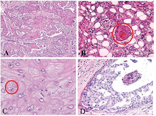 Figure 2. Microscopic features of case 1. H&E × 100 staining showed malignant squamous cells arranged in sheets (a), keratin-pearl formation (b), and intercellular bridges (c) with H&E × 400 staining. Intraductal carcinoma (d) can be seen in the tumor with H&E × 200 staining