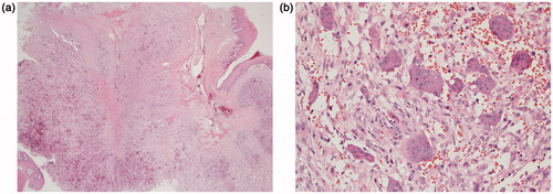 Figure 3. (a) Extension of the proliferation through the bone under the epithelium (1.25×, H&E staining). (b) Proliferation of stromal cells with multinucleated giant cells as well as extensive red blood cells extravasation (20×, H&E staining).