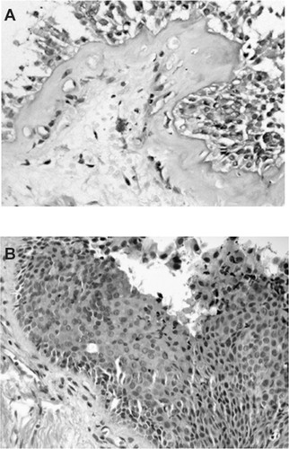 Figure 2 (A) Diffuse thickening of basement membrane (≥6.5 μm) in irreversible asthma. (PAS stain, ×20). (B) Squamous cell metaplasia with epithelial/subepithelial inflammation without thickening of basement membrane (H/E stain, ×20).