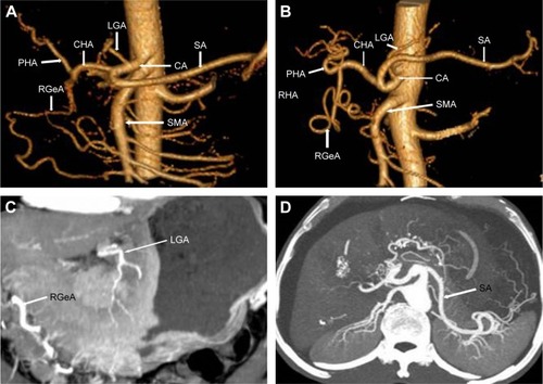 Figure 1 VR and MIP reconstruction techniques for perigastric arteries.