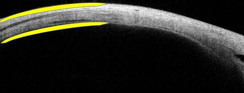 Figure 4 Well defined posterior ocular coat contours (outer and inner, yellow arcs).