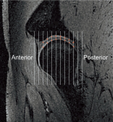 Figure 15. Method 1: On the sagittal images of the hip joint, every third image per series was sampled which added up to four to five images. In the software, a user-specified grid of approximately 15 vertical test lines was selected and superimposed on the images, and where the test lines intercepted the cartilage, the orthogonal distance through the cartilage was manually measured. The approximately 60–80 measured distances were summed, and the mean thickness of the acetabular and femoral cartilage was calculated (Citation85).