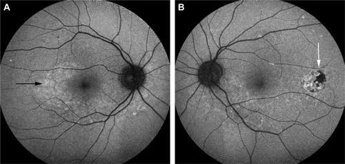 Figure 11 Short wavelength light (blue) FAF photographs of eyes of a patient with chronic VKHD.