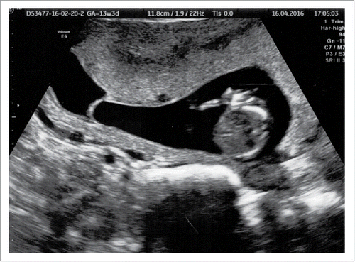 FIGURE 1. 12-week scan one of the fetuses, who has an upper limb hemimelia.