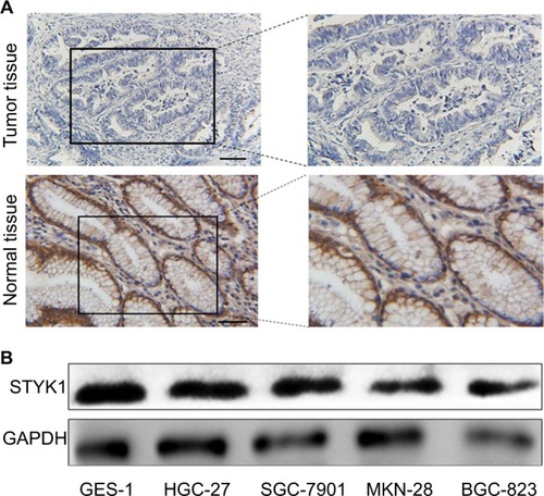 Figure 4 STYK1 protein expression in primary GC tissues and GC cell lines.Notes: (A) Representative immunohistochemical staining of STYK1 in GC tissues (0 points) and adjacent normal tissues (9 points). Scale bar: 100 μm, magnification for left panel ×40; right panel ×100. (B) Western blot of STYK1 protein expression in four GC cell lines and one normal GES-1.Abbreviations: GC, gastric cancer; GES-1, gastric mucosal epithelial cell line.