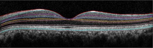 Figure 2 Retinal layers that were quantified are shown.
