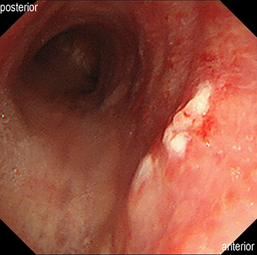 Figure 2 Bronchoscopic image. Mucosa before the tracheal bifurcation was edematous and erythematous.