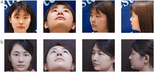 Figure 4. A 28-year-old Asian woman underwent twin tower folding ear cartilage rhinoplasty. Preoperative (a) and postoperative (b) facial profiles are shown.