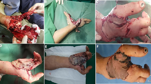 Figure 4 Severe injured proximal right hand with multiple fingers amputation and devascularization (A and B). Replantation and bone fixation by K-wires (C). Postoperative appearance with good color, warm, normal capillary refilling (D and E). 5th-week postoperative appearance (F).