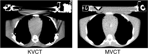 Figure 2. Kilovoltage and megavoltage CT images of the phantom with the SURLAS in place at approximately the same anatomical level. Please note the resolution of the MVCT image which has good soft tissue contrast as compared to the KVCT image. The KVCT image is degraded by artifacts specifically in regions near the high density materials of the SURLAS.