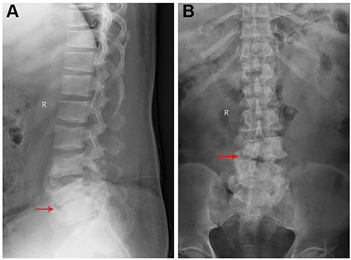 Figure 1 X-ray radiographs at admission. Lateral (A) and anteroposterior (B) radiographs show grade I L4 spondylolisthesis and loss of height of L4–5 disc (red arrow).