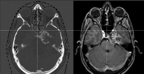 Figure 1. Case 1- Axial CT of the head in bone window showed calcified matrix and a thin peripheral calcified rim in petro-sphenoidal junction. Gadolinium-enhanced MRI, T1-weighted image shows mixed signal intensity in the tumour at the diagnosis.