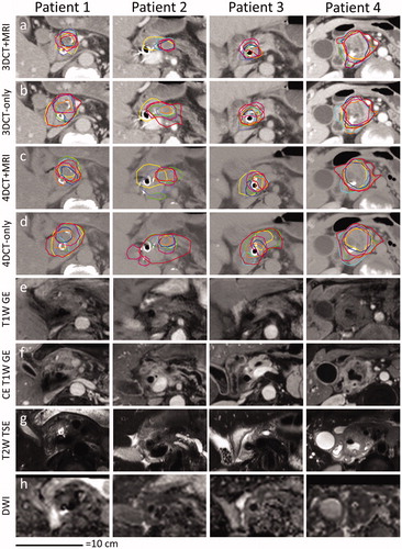 Figure 1. Example slices of GTV delineated on 3DCT + MRI (a) or 3DCT-only [Citation12] (b) and iGTV delineated on the Ave-IP using 4DCT + MRI (c) or 4DCT-only [Citation12] (d). The MRI images (e–h) show the manually selected corresponding slice. The apparent diffusion coefficient map from the DWI acquisition is shown (h). T1W: T1-weighted; GE: gradient echo; CE: contrast enhanced; T2W: T2-weighted; TSE: turbo spin echo; DWI: diffusion-weighted imaging.