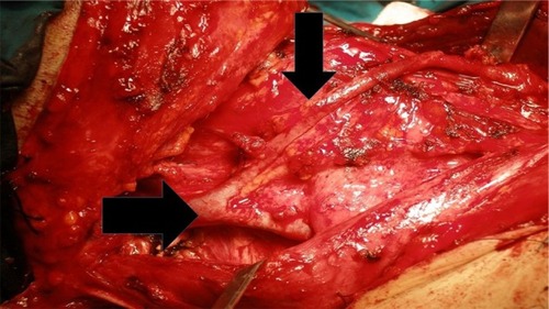 Figure 1 Anatomic findings during surgery.
