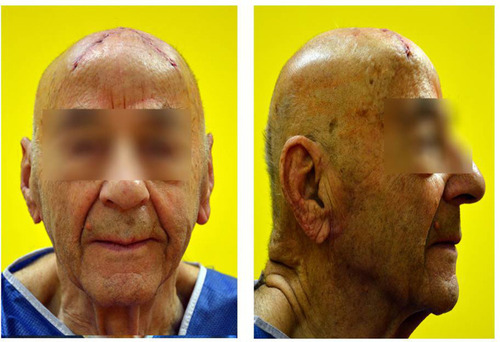Figure 3 Patient after surgery.