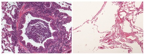 Figure 1 Representative photomicrograph of small airways disease and emphysema in a patient with chronic obstructive pulmonary disease.