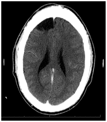Figure 1 Axial CT scan showing the first resection in this patient over the superior aspect of the right frontal convexity.