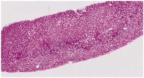 Figure 3. Microscopic examination of a liver biopsy with hepatic sinusoidal dilatation. Histopathology of a liver biopsy with hepatic sinusoidal dilatation characterized by widening of hepatic sinusoids in a patient with inflammatory bowel disease during thioguanine treatment (Hematoxylin-Eosin stained).