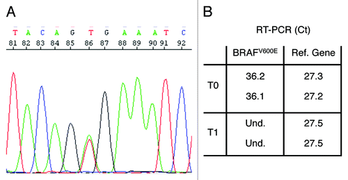 Figure 3. Detection of the BRAFV600E mutation in patient's CRC tissue and plasma. (A) Electropherogram showing the heterozygous BRAFV600E mutation in DNA isolated from patient's CRC tissue. (B) Allele-specific Q-PCR detection of the BRAFV600E mutation in plasma free DNA reveals the presence of circulating tumor DNA before treatment (T0) but not 12 wk after treatment initiation (T1). Data are reported as averages of the threshold cycles (Ct) obtained in two different Q-PCR for the BRAFV600E amplicon and the reference gene amplicon.