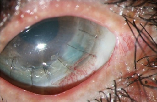 Figure 6 Persistent epithelial defect 3 months after penetrating keratoplasty.