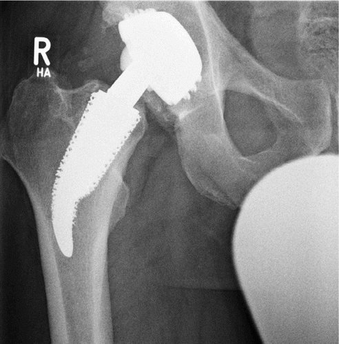 Figure 1. Standard anteroposterior radiograph of the pelvis with regular position of the CUT prosthesis. No signs of loosening 4 years after surgery.