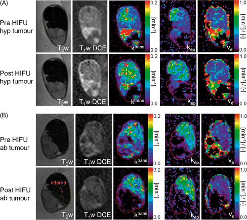 Figure 6. T2‐weighted images, T1‐weighted DCE‐MRI images and parametric maps of ktrans [min− 1], kep [min−1] and ve [–] of the treated area before and after (A) hyperthermia treatment (data animal 2) and (B) ablation treatment of the tumour (data animal 7). A red ROI is manually drawn around the tumour in the parametric maps. The orange arrow points at local oedema visible after HIFU ablation treatment on the T2‐weighted scan. hyp, hyperthermia; ab, ablation.