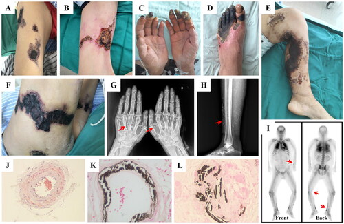 Figure 1. Clinical manifestations, imaging features and histopathology of calciphylaxis.(A-F) Calciphylaxis patients have multiple skin lesions, that the characteristic lesions manifest as livedo reticularis, necrotic ulcers, and black eschar. (G-H) X-ray shows diffuse calcium deposition in subcutaneous tissue of the hands and lower limbs as white mass deposits (red arrows). (I) Bone scintigraphy reveals abnormal radioactivity concentrations in multiple soft tissues throughout the body, with a black linear distribution along the subcutaneous surface (red arrows). (J-L) Skin biopsy specimens of calciphylaxis show calcification of the media membrane of subcutaneous arterioles with extensive calcium deposition in extravascular interstitial tissue. Alizarin red S staining in J, von Kossa staining in K and L, magnification ×400.