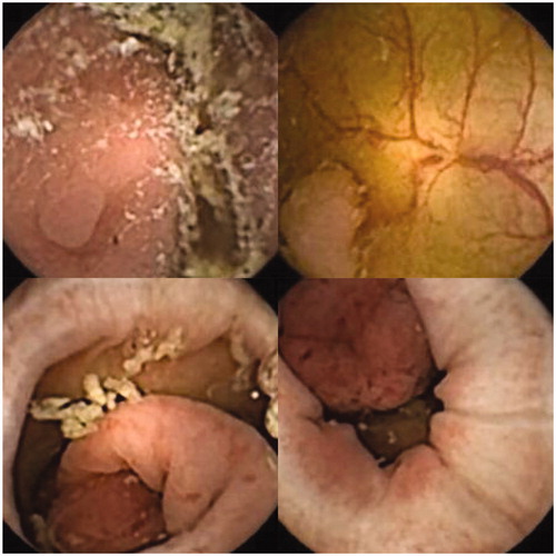 Figure 1. Colorectal polyps of different size, color and morphology.