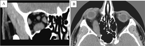 Figure 2 Coronal (A) and axial (B) CT slices shows massive enlargement of inferior rectus in right orbit.