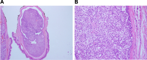 Figure 8 Dermal tumor with clear cells.