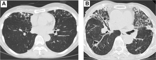 Figure 2 Radiological findings were suspicious for nontuberculous mycobacteria pulmonary disease. (A) Nodular shadow with bronchiectatic changes observed mainly in the middle and lingular bronchopulmonary segments. (B) Bronchiectasis with fibrous cavitary lesions.