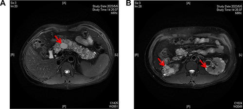 Figure 3 Abdominal MRI of patient two revealed multiple cysts in the pancreas (A) (the red arrow), as well as multiple cysts and solid nodules in both kidneys (B) (the red arrows).