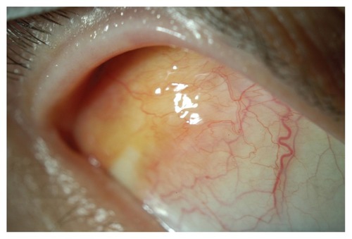 Figure 1 Bilateral yellow conjunctival lesions from necrobiotic xanthogranuloma and chronic lymphocytic leukemia.